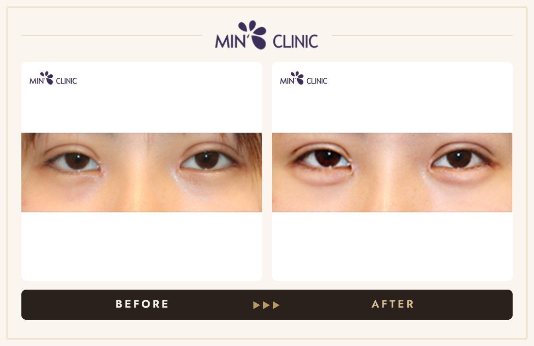 Aegyo-sal filler before and after, case 21 – MIN Clinic Seoul