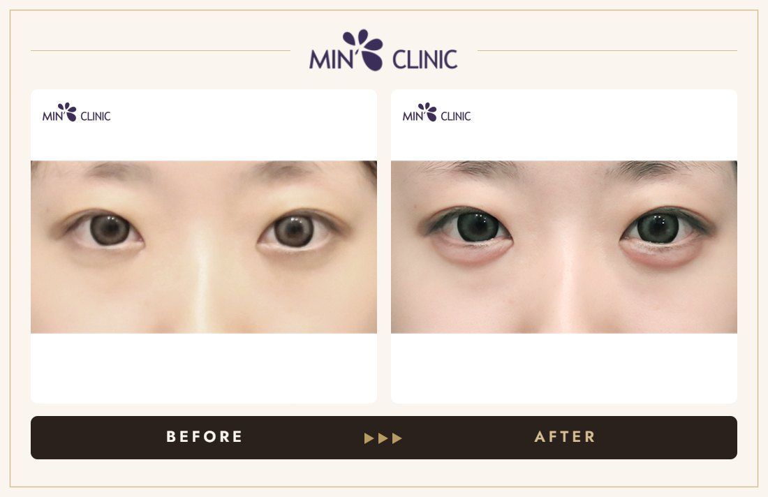 Aegyo-sal filler before and after, case 22 – MIN Clinic Seoul