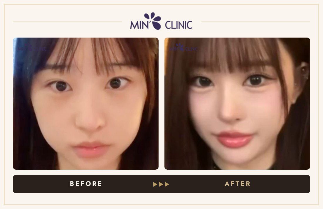 Aegyo-sal filler before and after, case 23 – MIN Clinic Seoul
