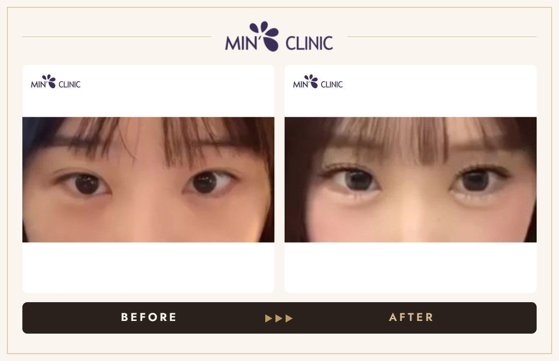 Aegyo-sal filler before and after, case 24 – MIN Clinic Seoul