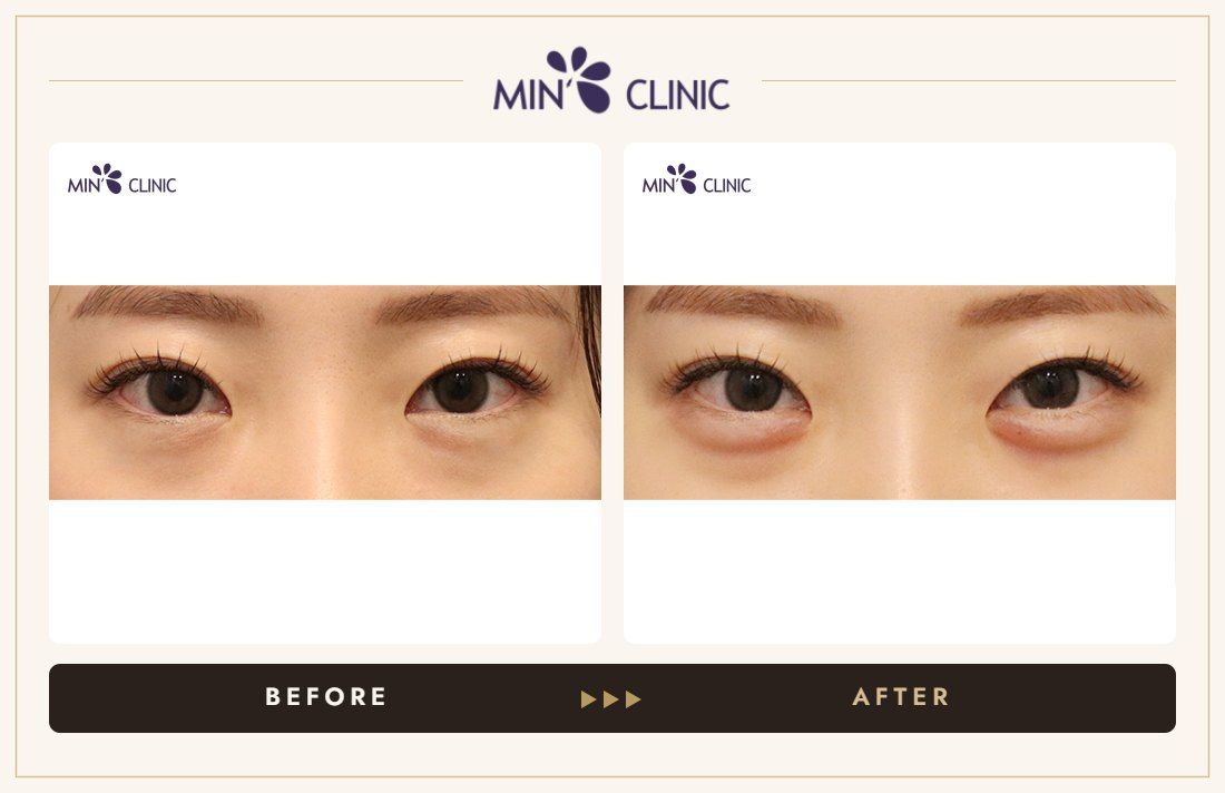 Aegyo-sal filler before and after, case 25 – MIN Clinic Seoul