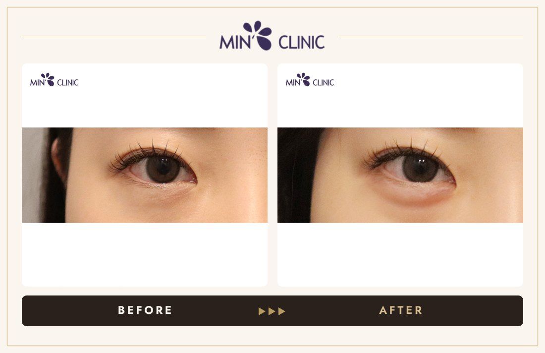 Aegyo-sal filler before and after, case 26 – MIN Clinic Seoul