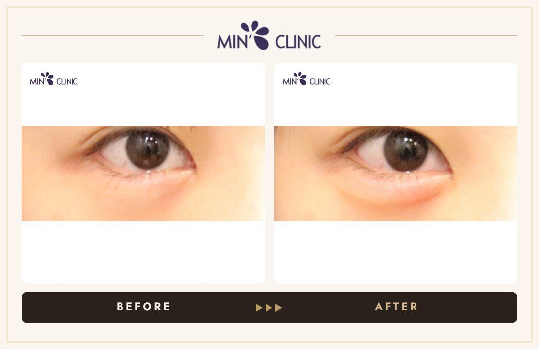 Aegyo-sal filler before and after, case 27 – MIN Clinic Seoul