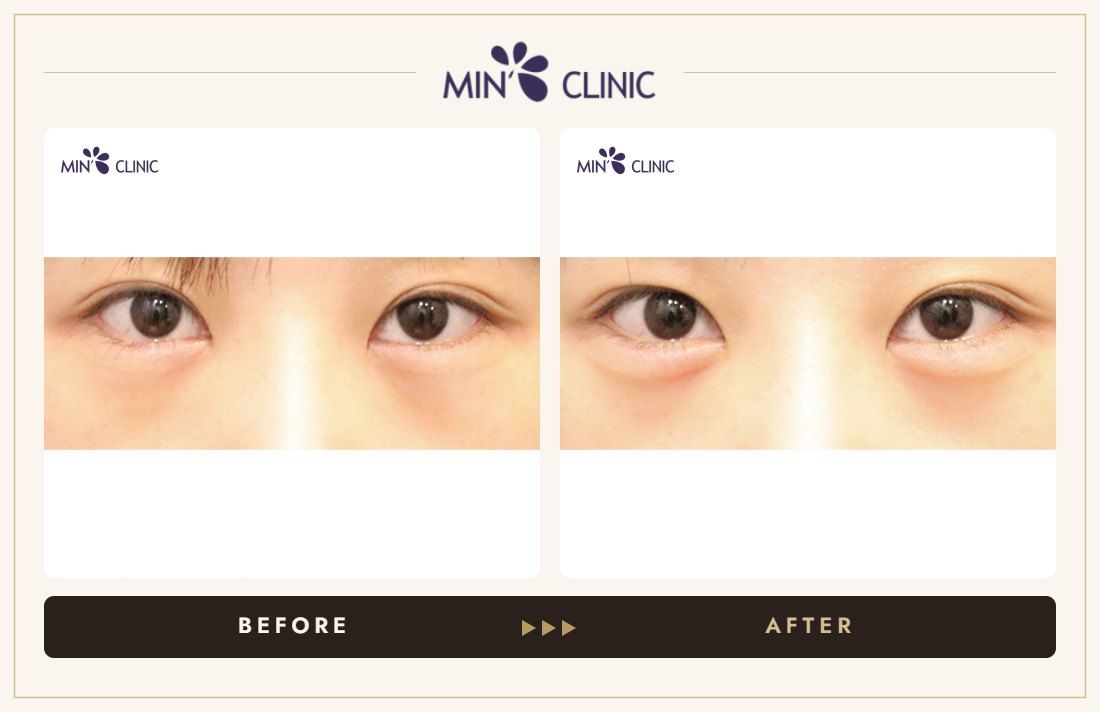 Aegyo-sal filler before and after, case 28 – MIN Clinic Seoul
