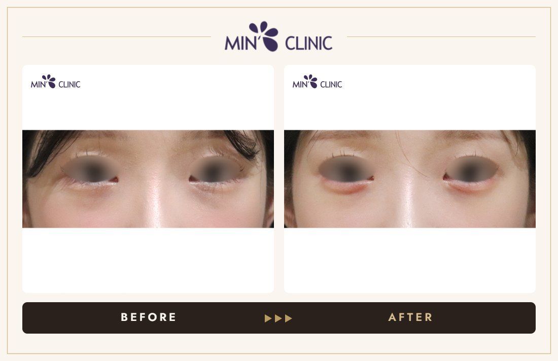 Aegyo-sal filler before and after, case 29 – MIN Clinic Seoul