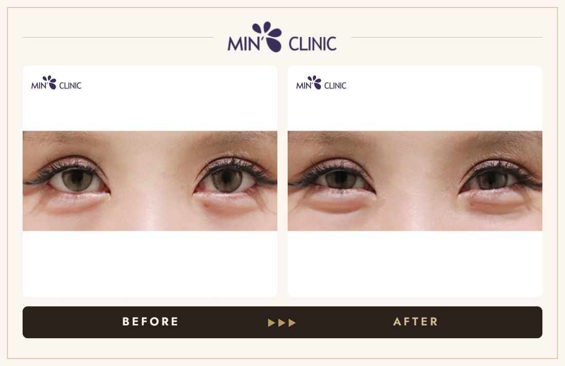 Aegyo-sal filler before and after, case 30 – MIN Clinic Seoul