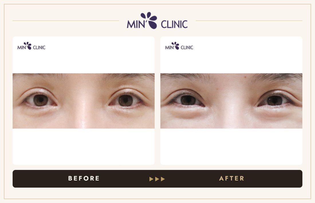 Under-eye (aegyo-sal) filler before and after – MIN Clinic Gangnam, Seoul