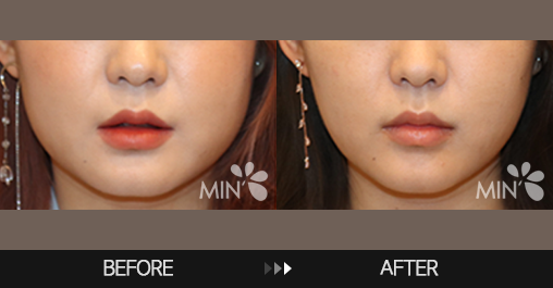 Double chin injections before and after