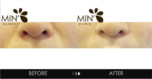 Marionette line filler before and after