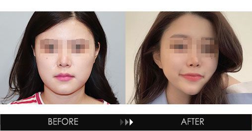 Facial contouring injection before and after