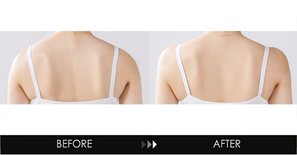 Shoulder contouring before and after