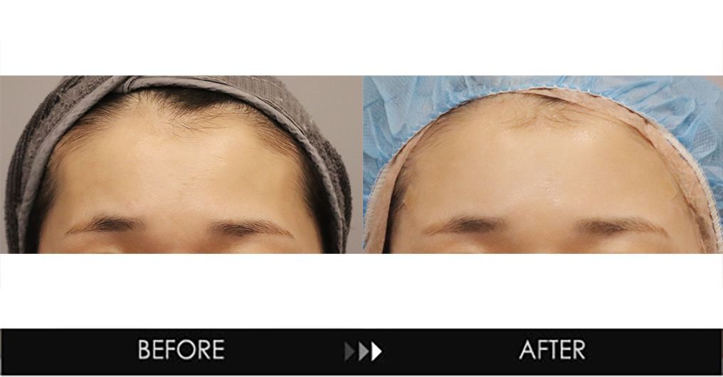 Brow bone filler before and after