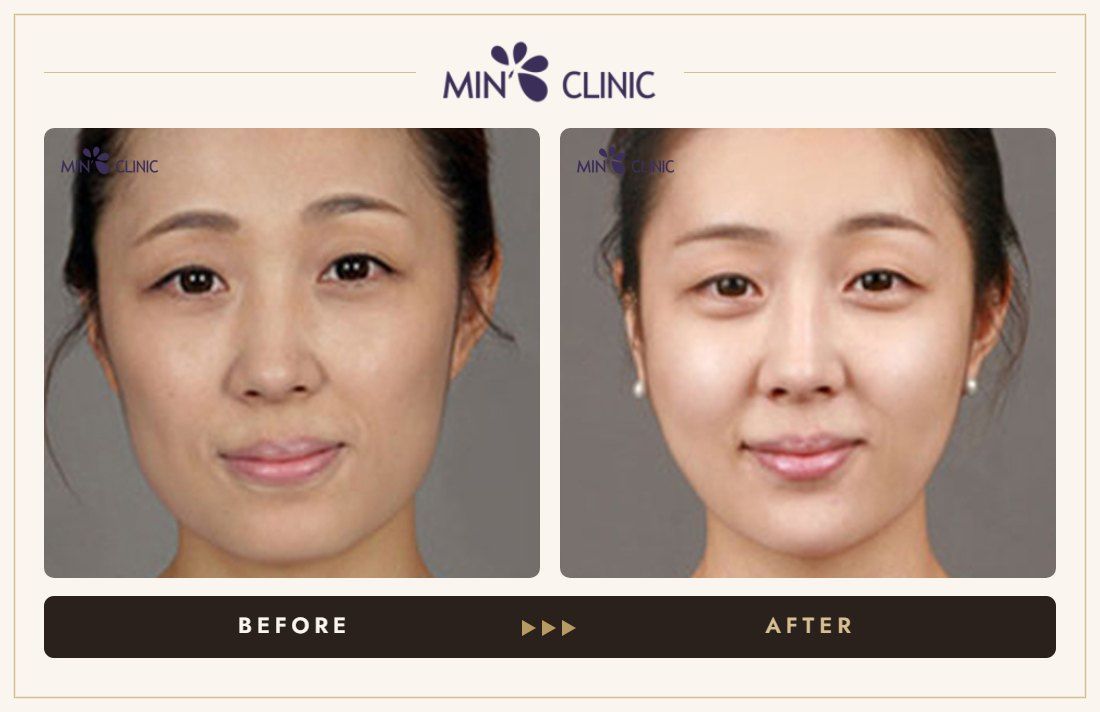 Baby face filler before and after, case 2 – MIN Clinic Seoul