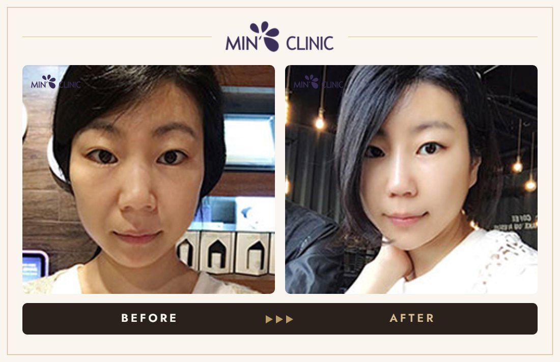 Baby face filler before and after, case 3 – MIN Clinic Seoul