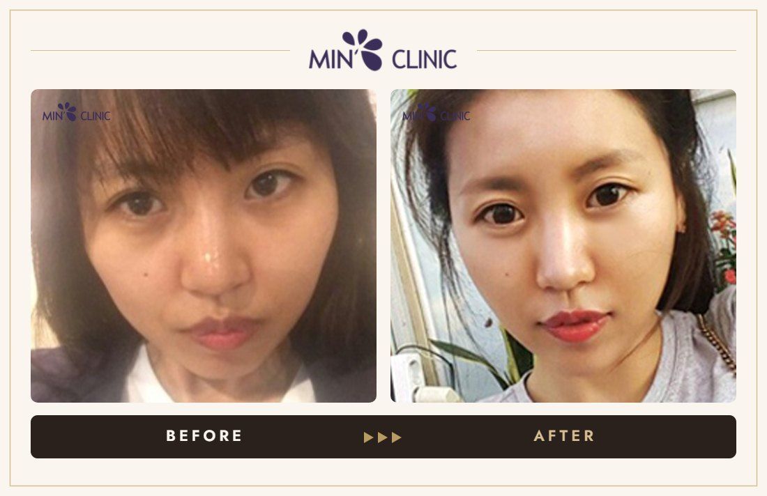 Baby face filler before and after – MIN Clinic Gangnam, Seoul