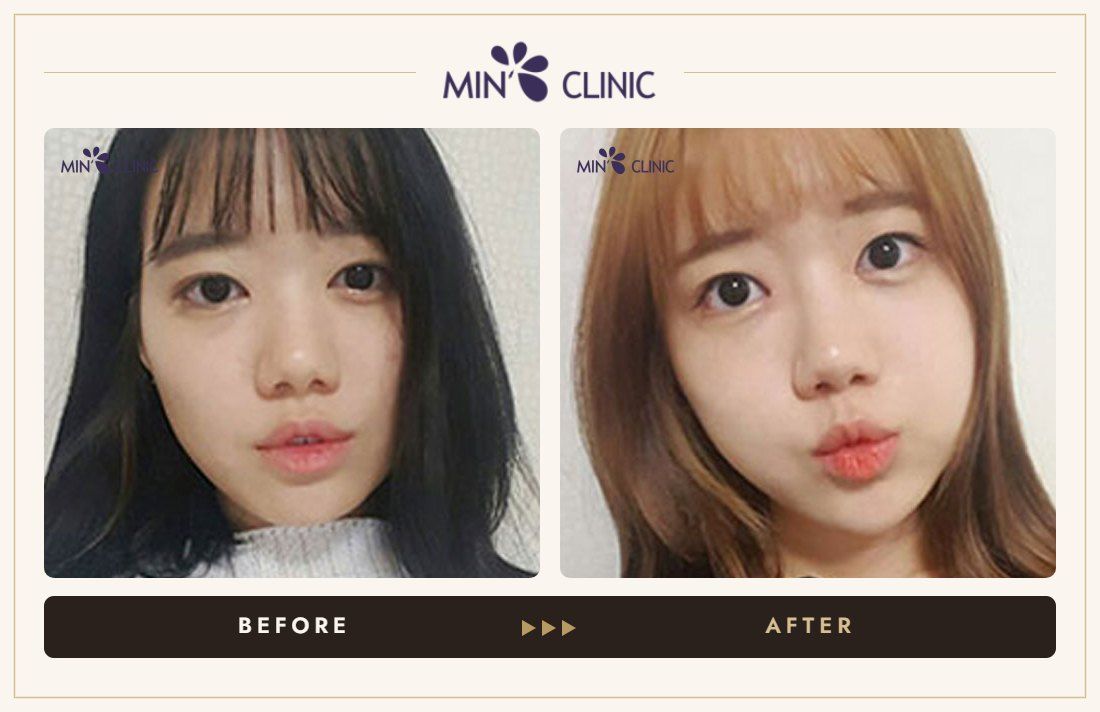 Baby face filler before and after, case 1 – MIN Clinic Seoul