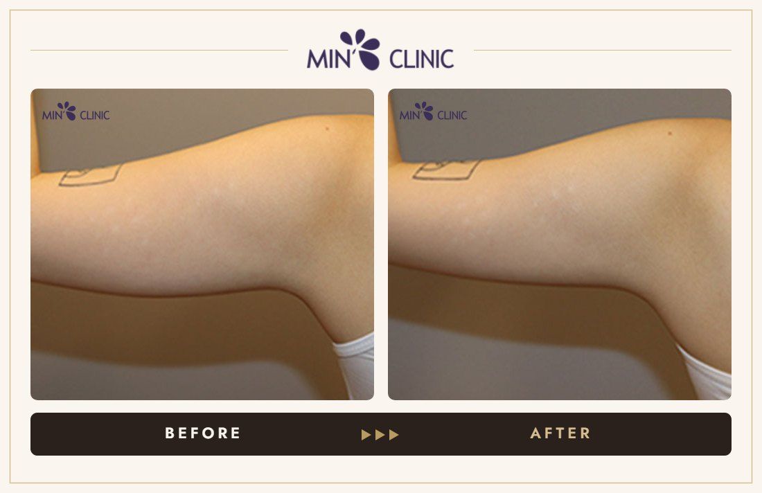 Arm Quick Slim before and after, case 11 – MIN Clinic Seoul