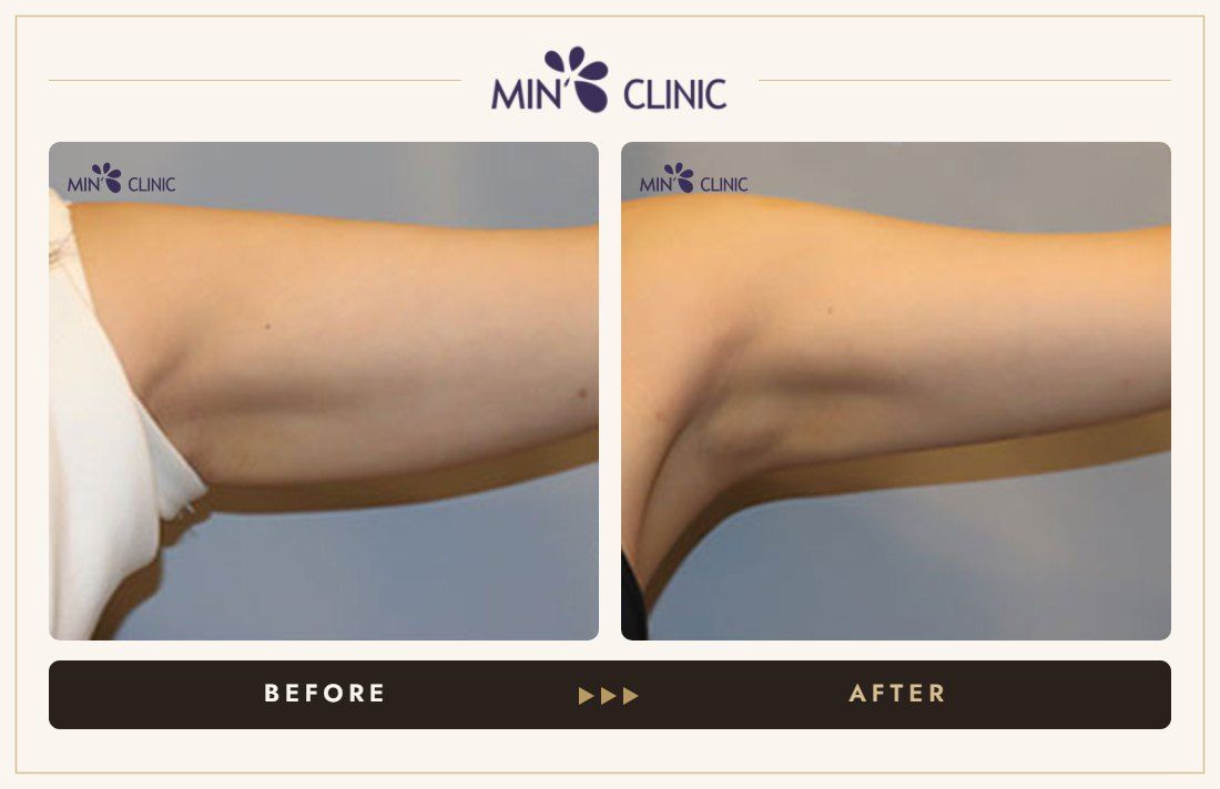 Arm Quick Slim before and after, case 12 – MIN Clinic Seoul