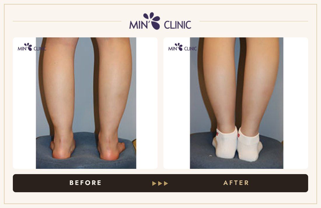 Calf Quick Slim before and after, case 2 – MIN Clinic Seoul