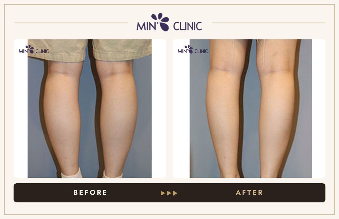 Calf Quick Slim before and after, case 3 – MIN Clinic Seoul