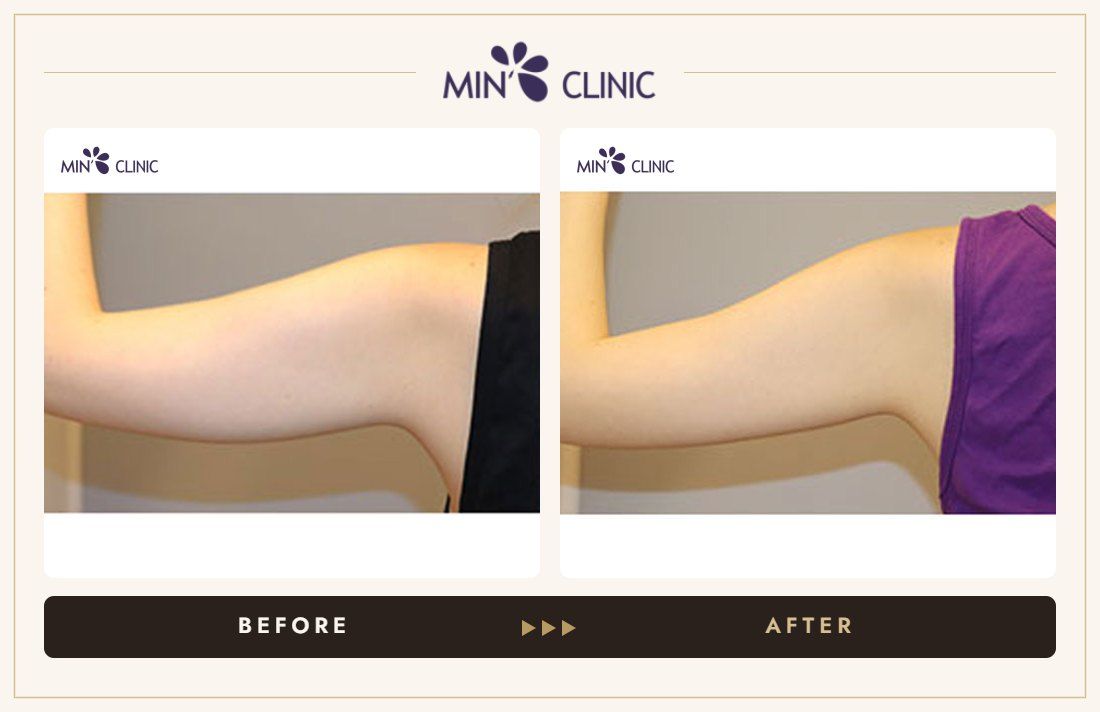 Arm Quick Slim before and after, case 13 – MIN Clinic Seoul