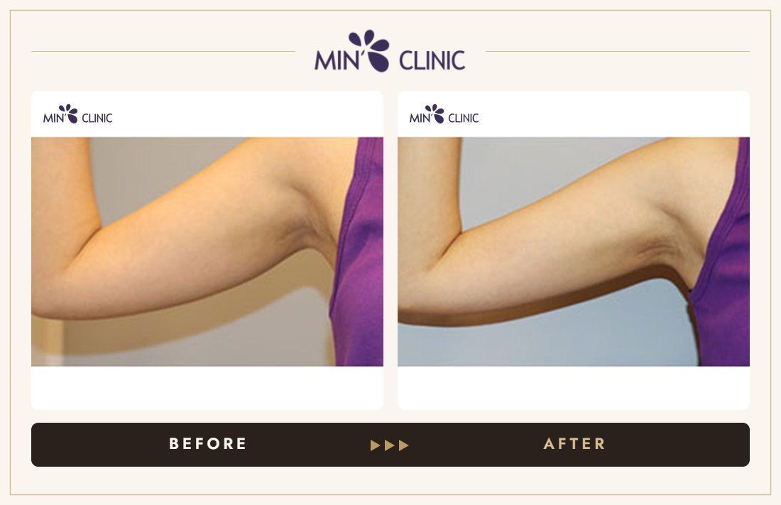 Arm Quick Slim before and after, case 14 – MIN Clinic Seoul