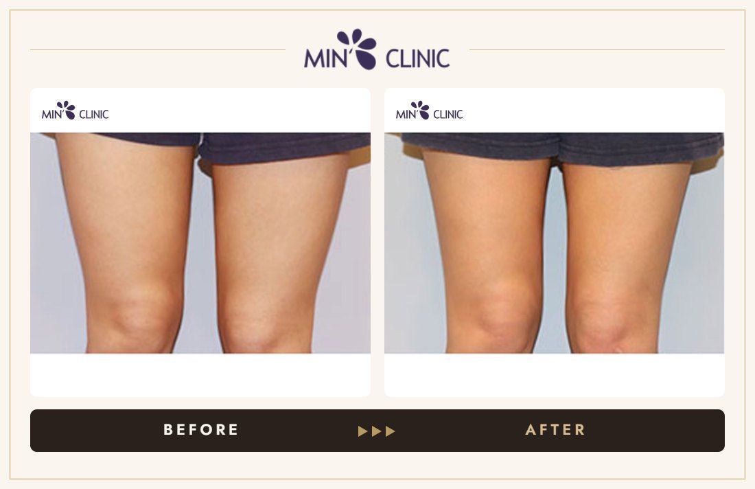 Thigh Quick Slim before and after, case 1 – MIN Clinic Seoul