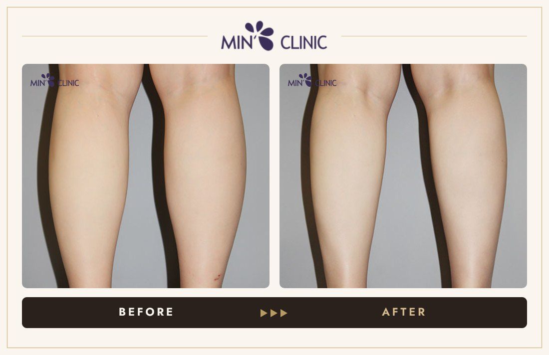 Calf Botox before and after, case 3 – MIN Clinic Seoul
