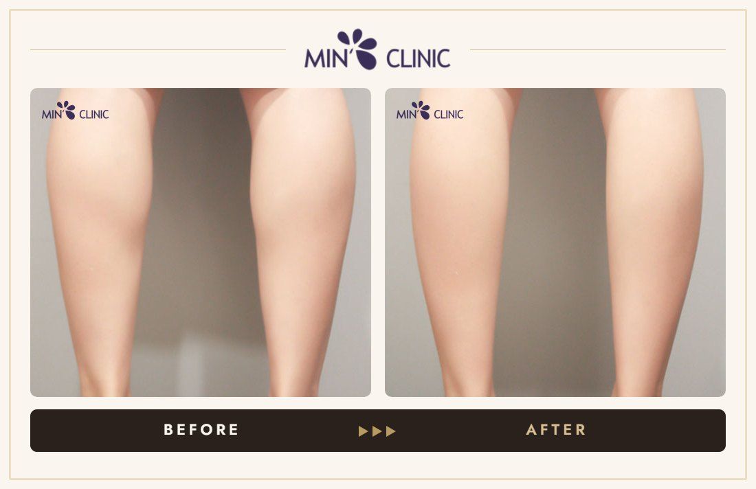 Calf Botox before and after, case 4 – MIN Clinic Seoul