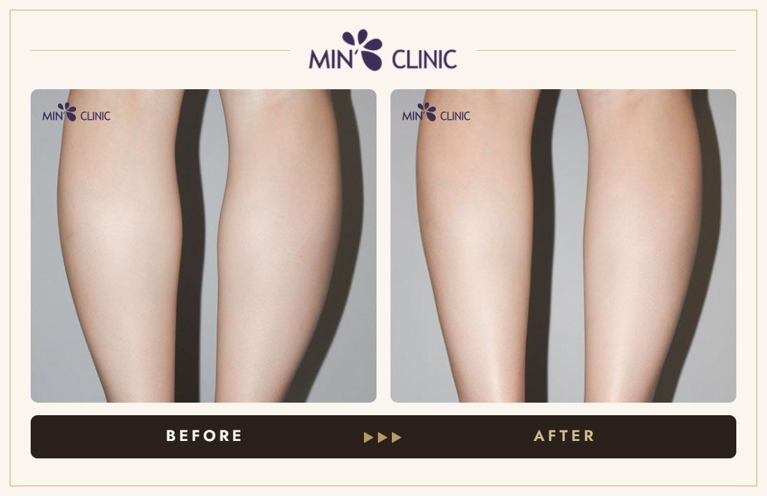 Calf Botox before and after, case 5 – MIN Clinic Seoul