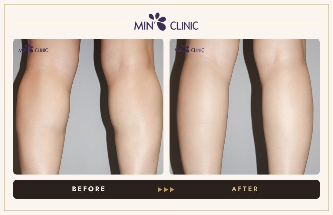 Calf Botox before and after, case 6 – MIN Clinic Seoul