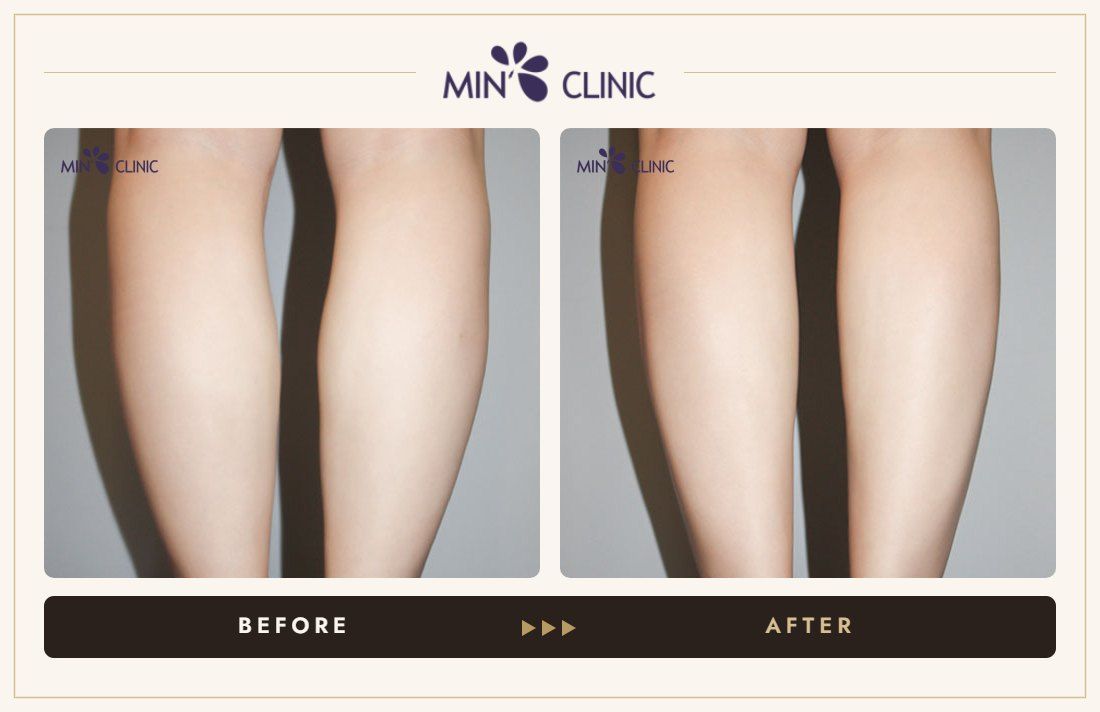 Calf Botox before and after, case 7 – MIN Clinic Seoul