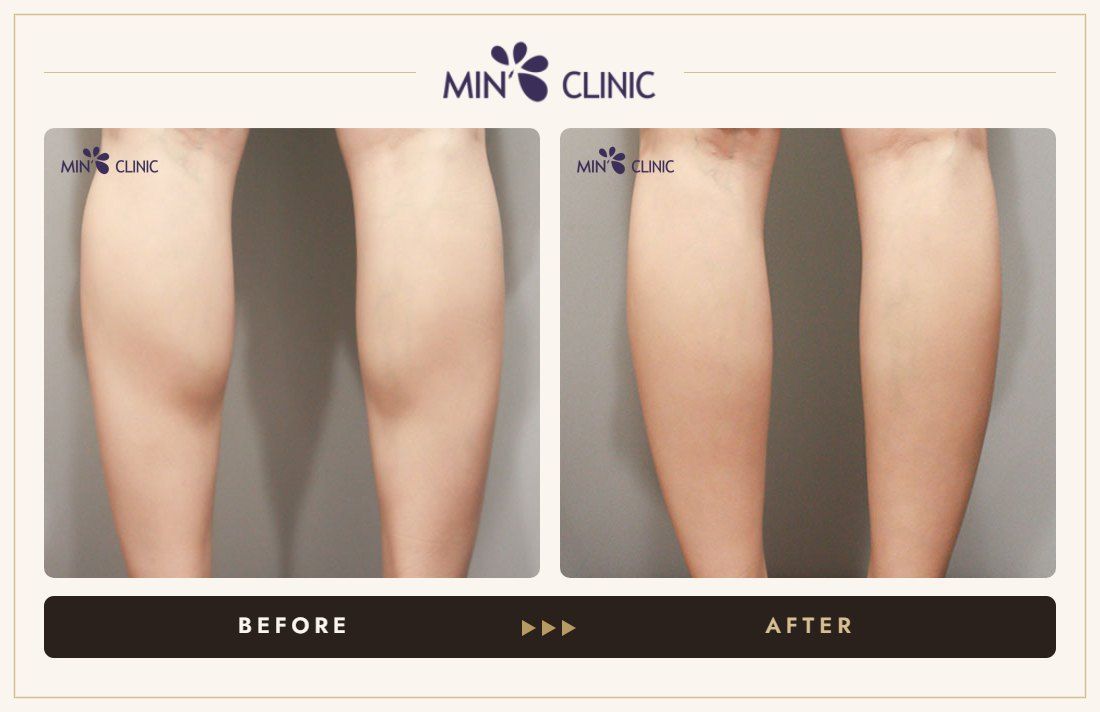 Calf Botox before and after, case 8 – MIN Clinic Seoul