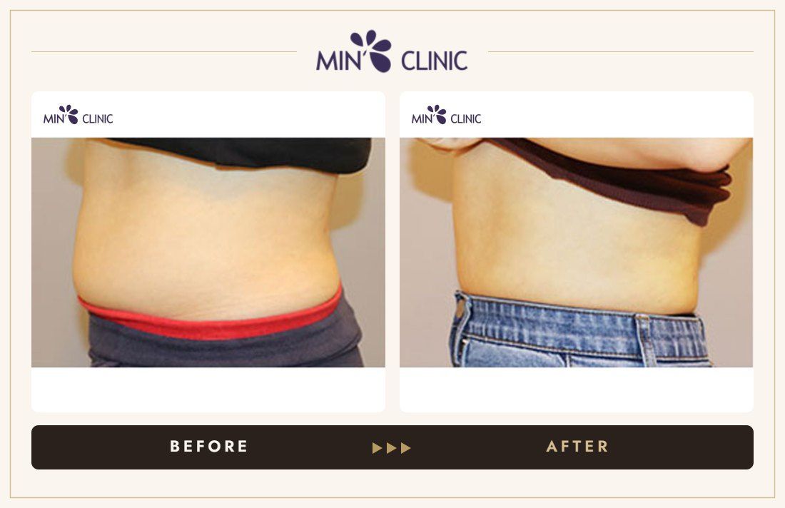 Abdomen Quick Slim before and after, case 4 – MIN Clinic Seoul
