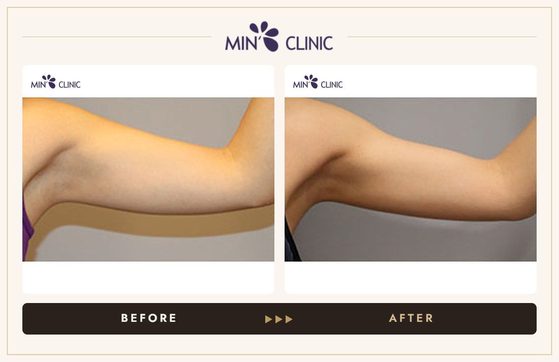 Arm Quick Slim before and after, case 15 – MIN Clinic Seoul