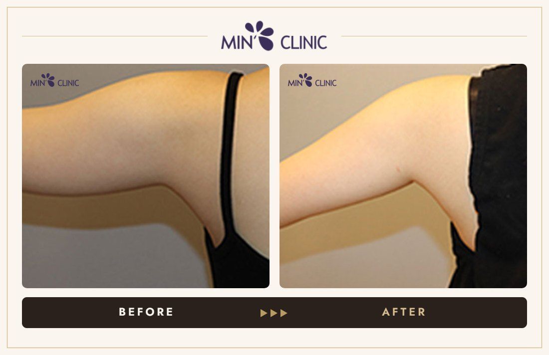 Arm Quick Slim before and after, case 16 – MIN Clinic Seoul