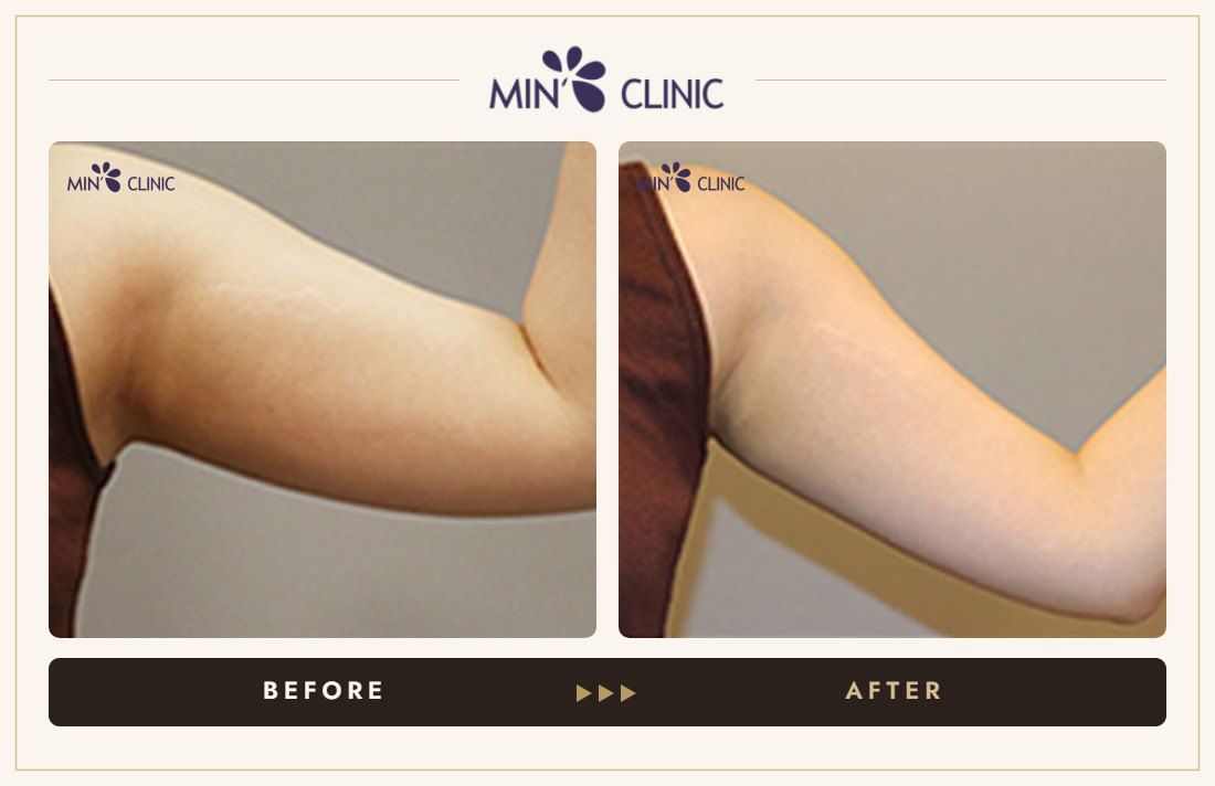 Arm Quick Slim before and after, case 17 – MIN Clinic Seoul