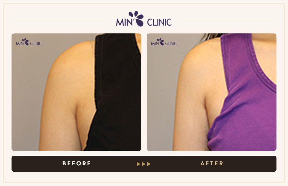 Arm Quick Slim before and after, case 18 – MIN Clinic Seoul