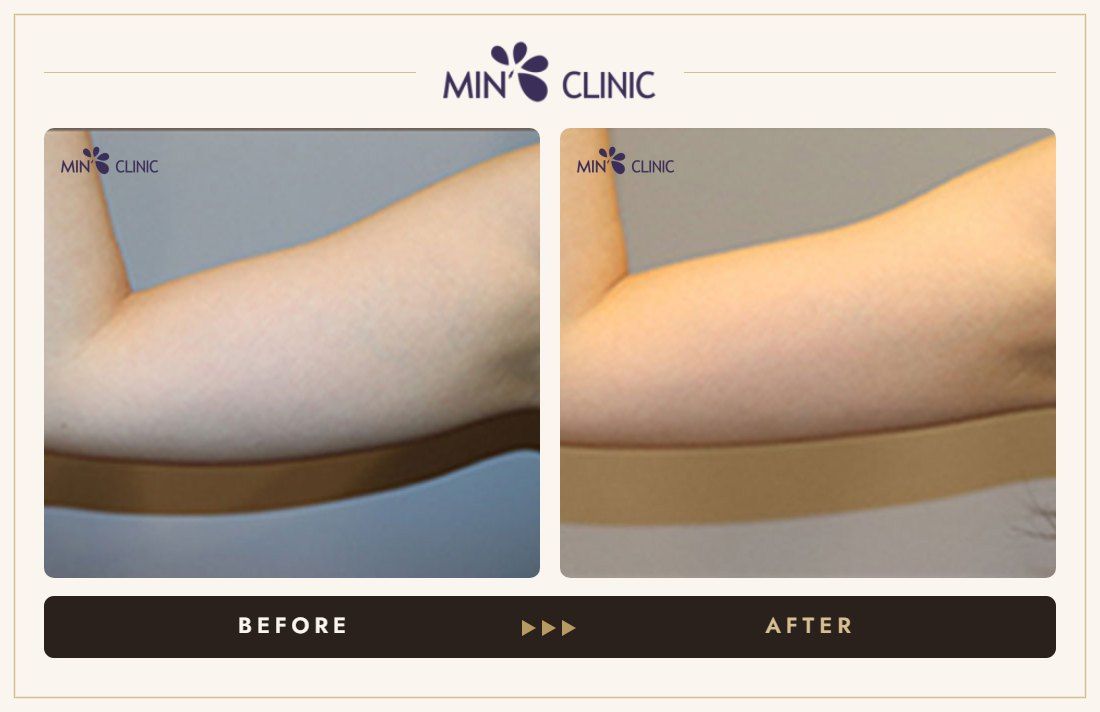 Arm Quick Slim before and after, case 19 – MIN Clinic Seoul