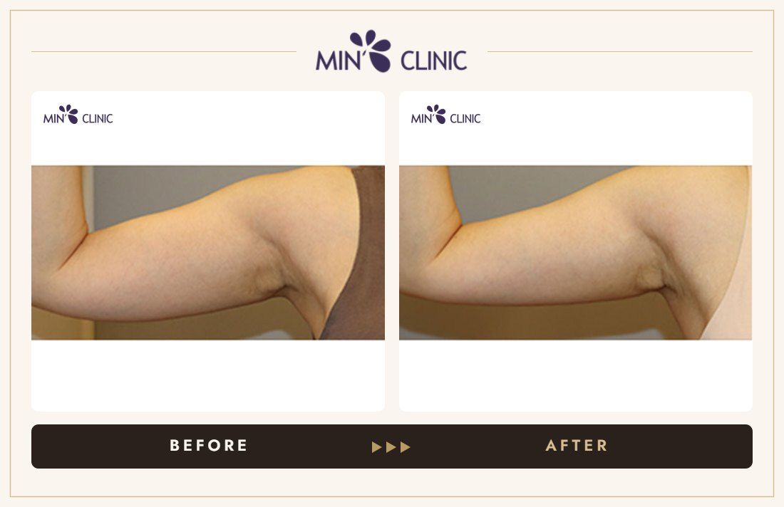 Arm Quick Slim before and after, case 20 – MIN Clinic Seoul