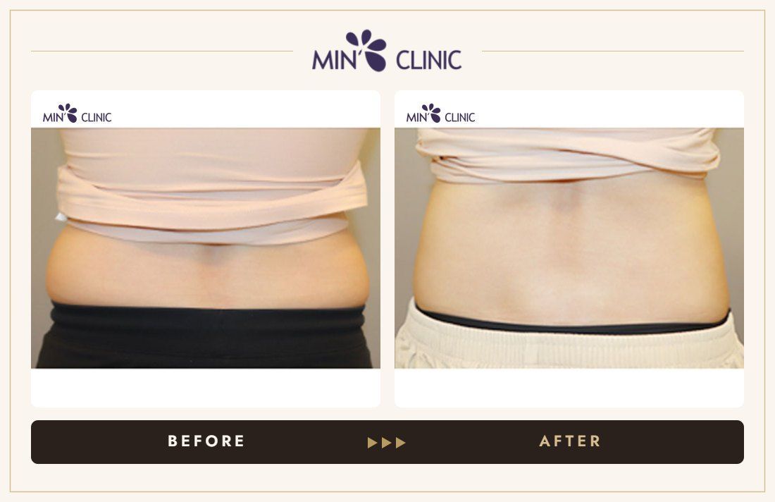 Abdomen Quick Slim before and after, case 5 – MIN Clinic Seoul
