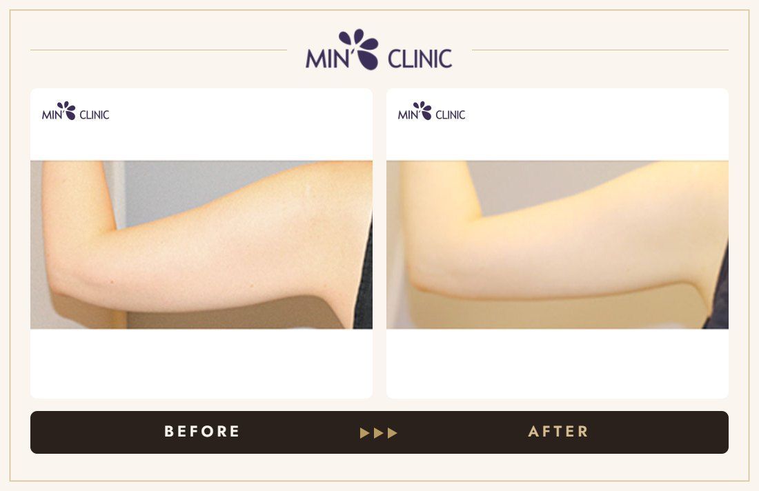 Arm Quick Slim before and after, case 21 – MIN Clinic Seoul