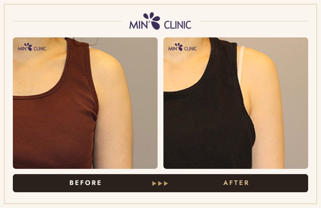 Arm Quick Slim before and after, case 22 – MIN Clinic Seoul