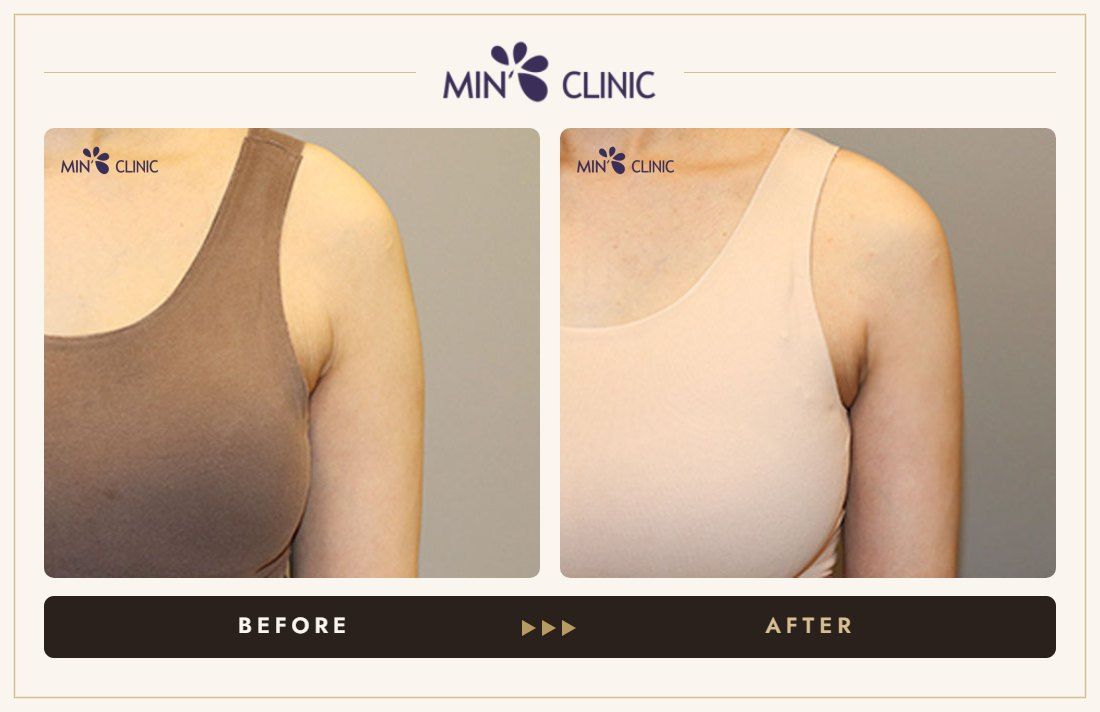 Arm Quick Slim before and after, case 23 – MIN Clinic Seoul