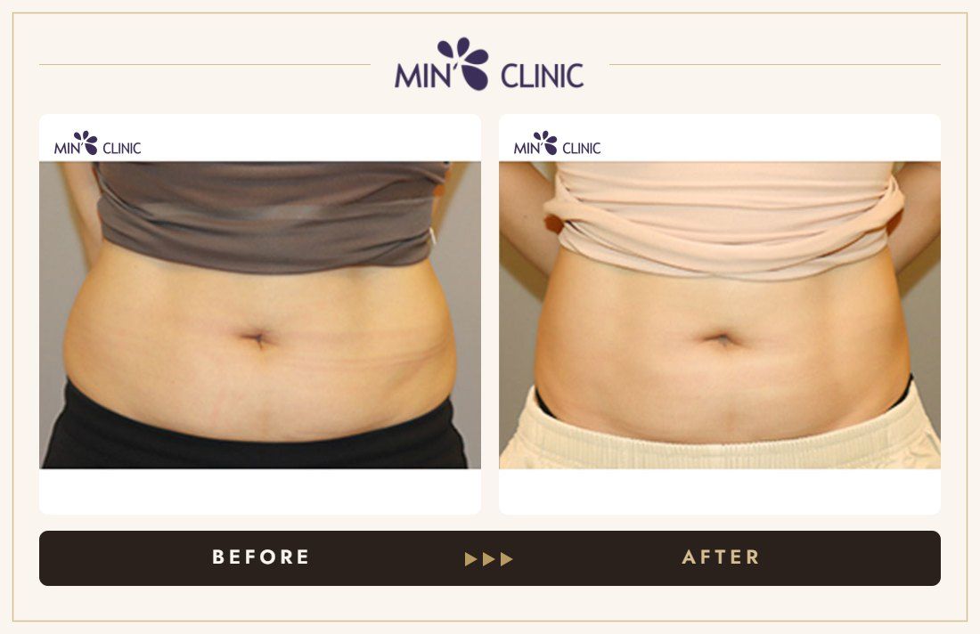 Abdomen Quick Slim before and after, case 6 – MIN Clinic Seoul