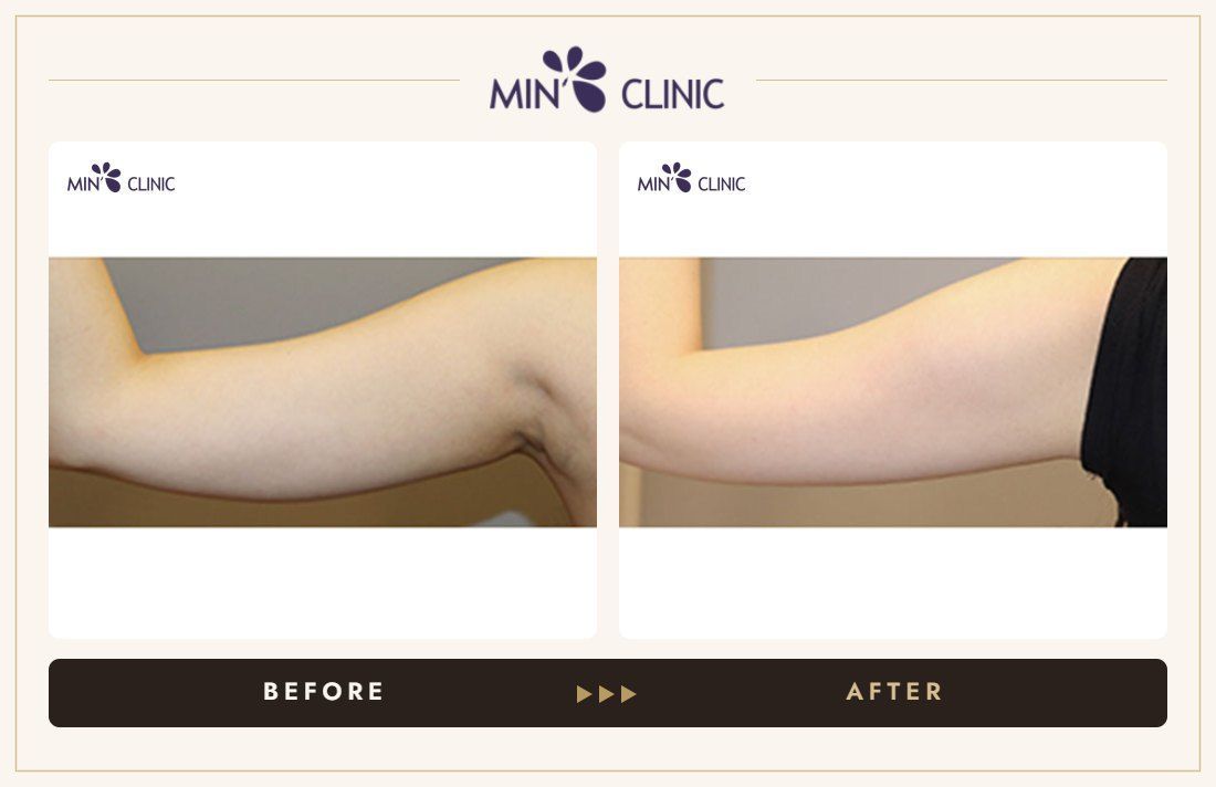 Arm Quick Slim before and after, case 24 – MIN Clinic Seoul