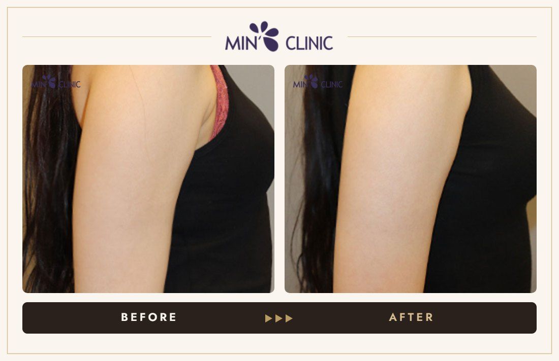 Arm Quick Slim before and after, case 25 – MIN Clinic Seoul