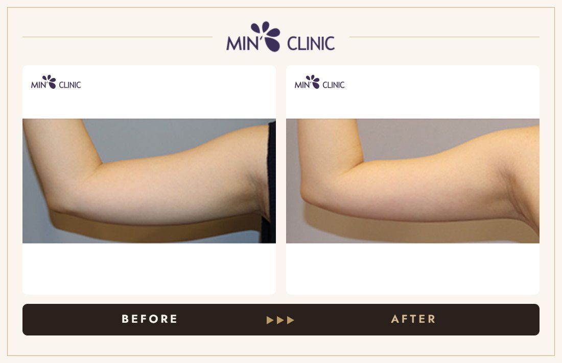 Arm Quick Slim before and after, case 26 – MIN Clinic Seoul