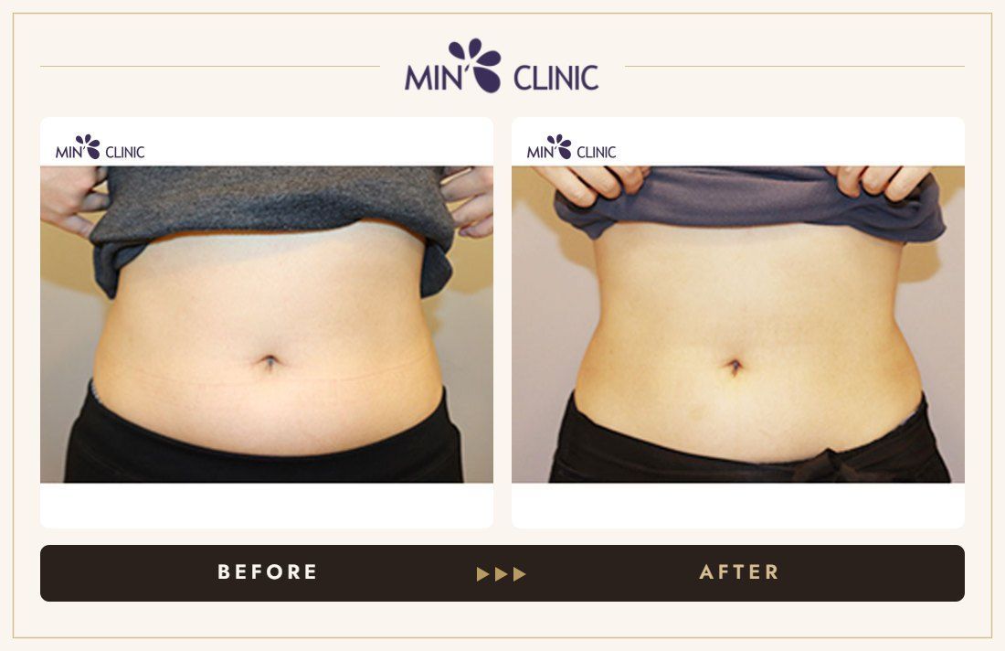 Abdomen Quick Slim before and after, case 7 – MIN Clinic Seoul