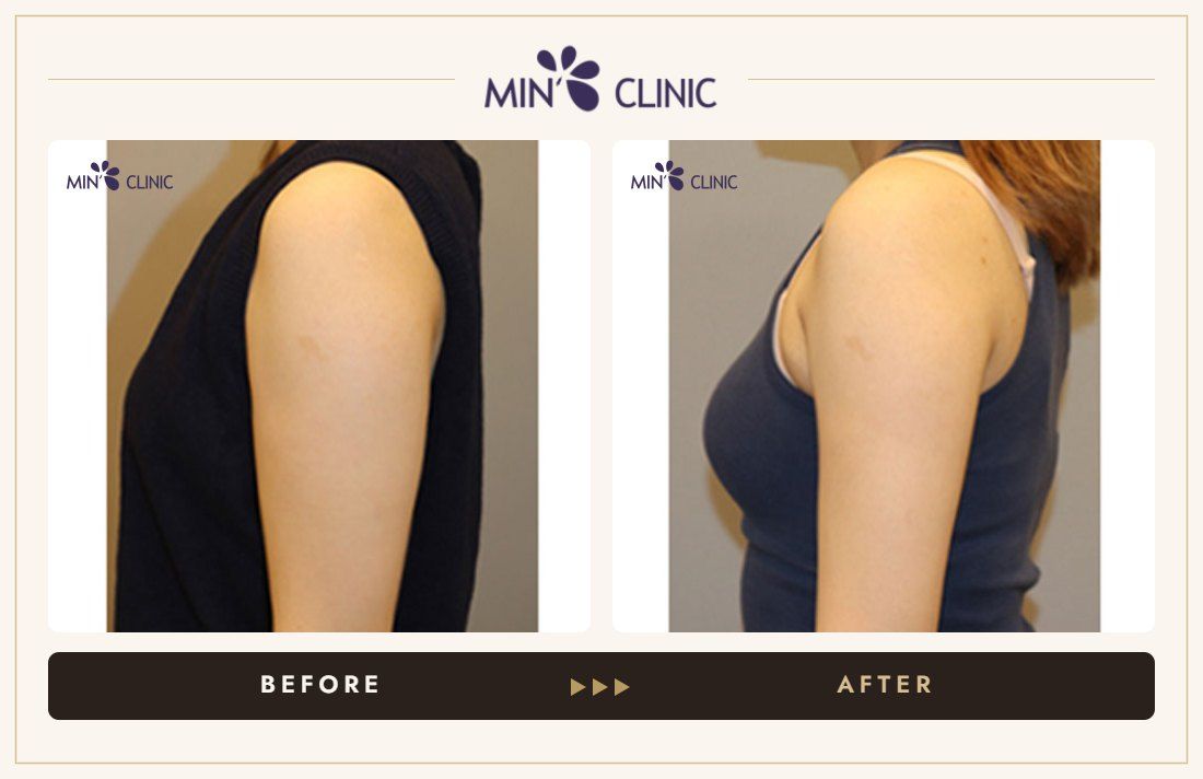 Arm Quick Slim before and after, case 27 – MIN Clinic Seoul